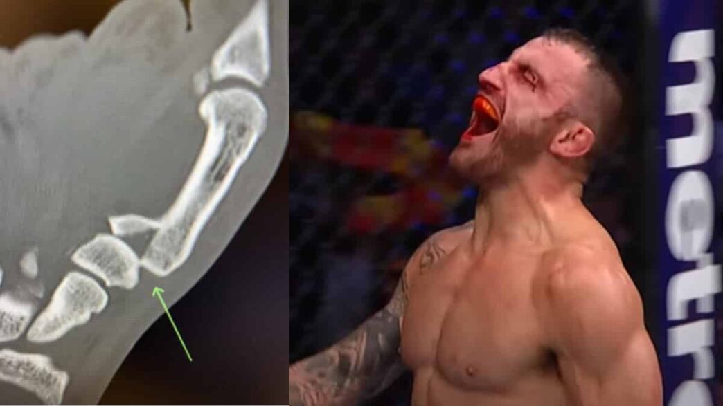 Volkanovski-Blessure