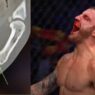 Volkanovski-Blessure