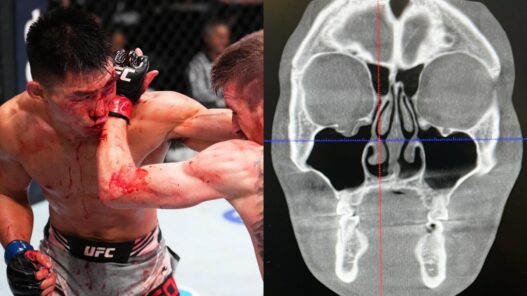 song-yadong-blessure