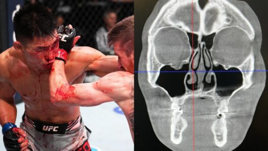 song-yadong-blessure