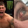 darren till blessure œil
